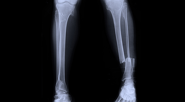 crush injury