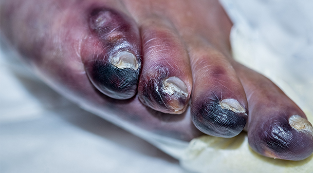gangrene
