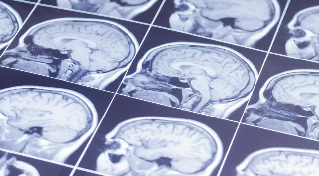 Encephalomalacia