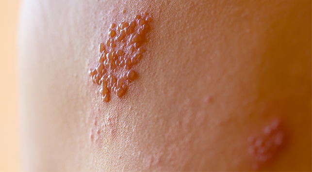 Herpes Zoster