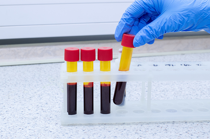 Cek Anti HSV2 IgM