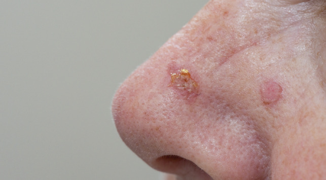 Actinic Keratosis - Pengertian, Gejala, dan Cara Mengobatinya