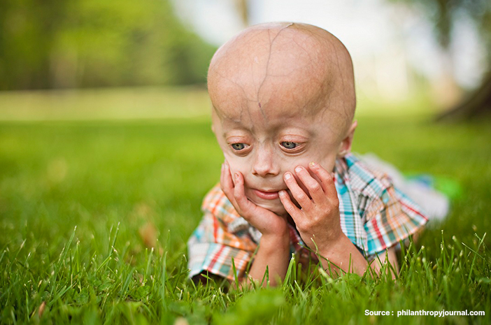 progeria