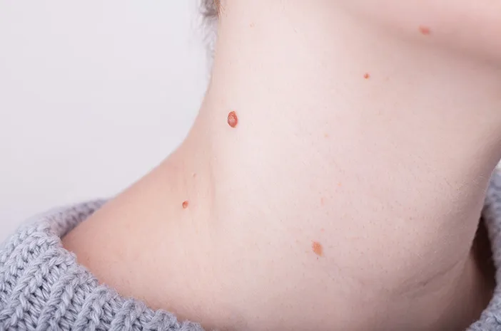 Amankah Menggunakan Obat Kutil yang Dijual Bebas?