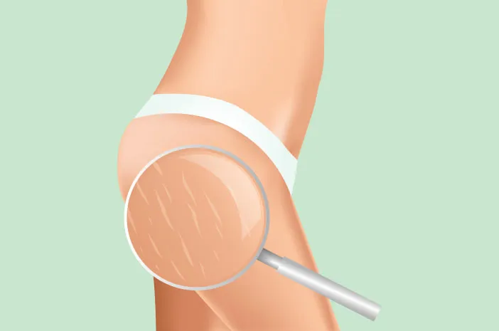 Pengobatan Medis untuk Mengatasi Stretch Mark pada Remaja