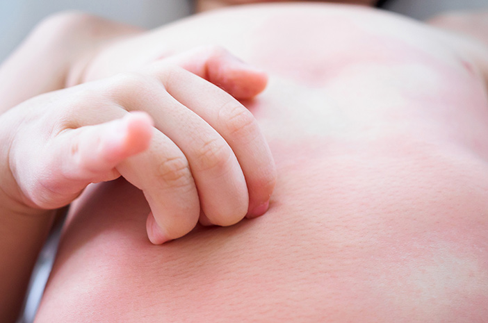 Benarkah Anak yang Biduran Tidak Boleh Mandi?