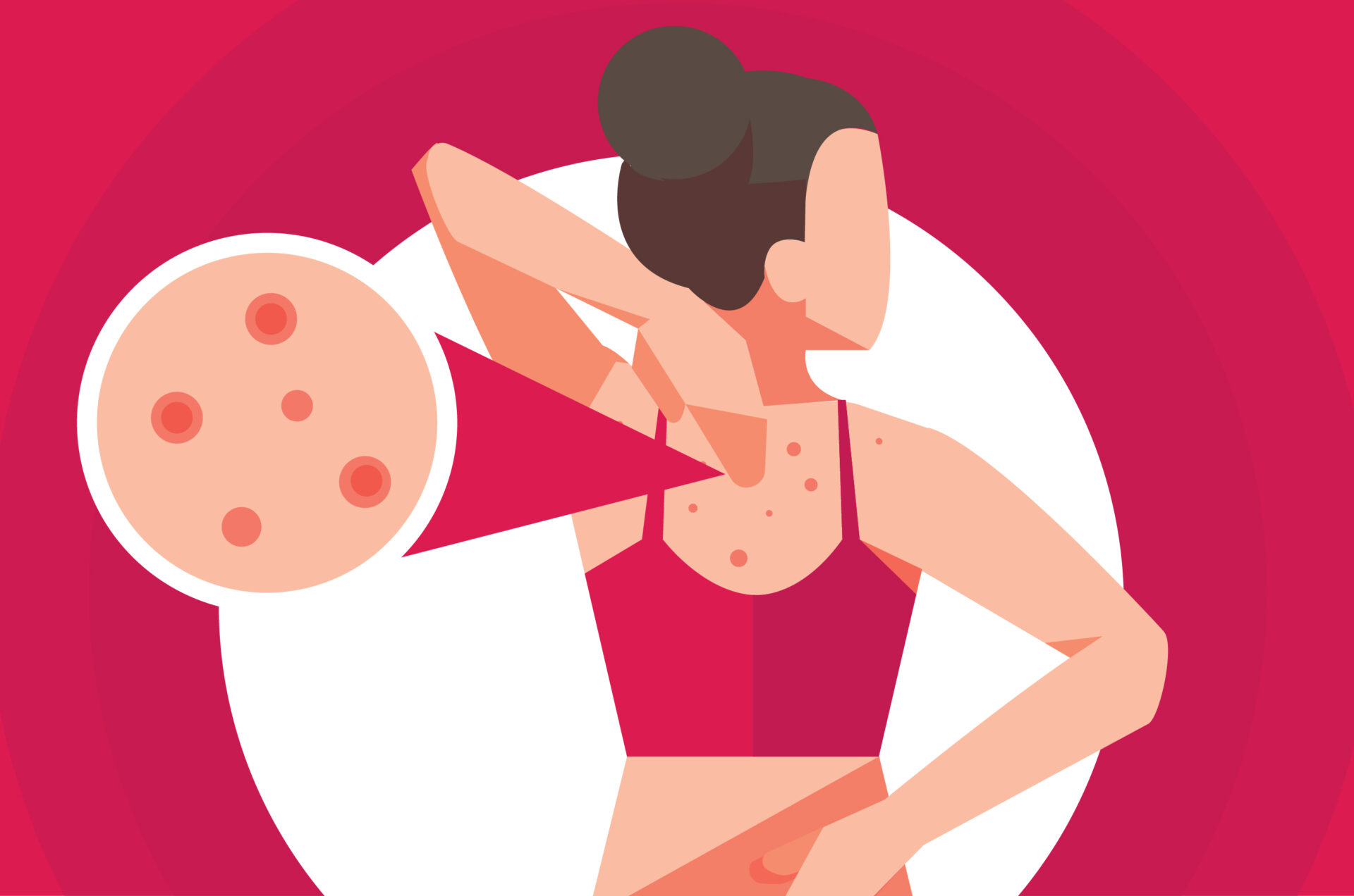 Ini 4 Penyebab Munculnya Jerawat di Badan