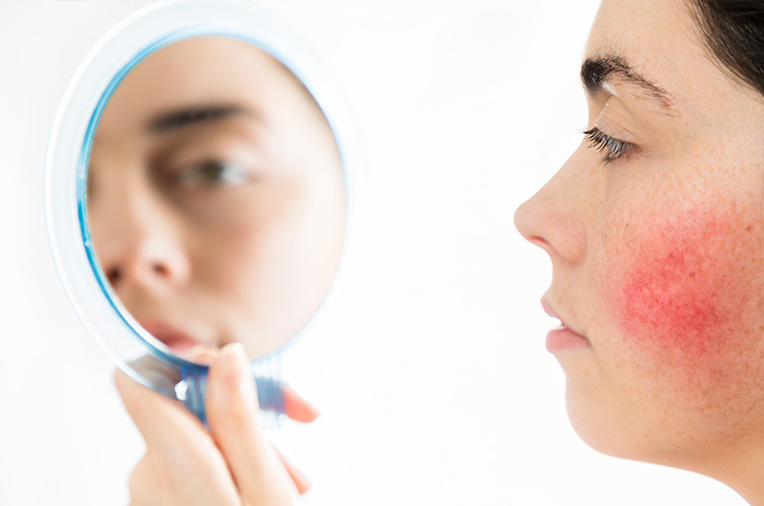 Ketahui 10 Fakta tentang Penyakit Kulit Rosacea
