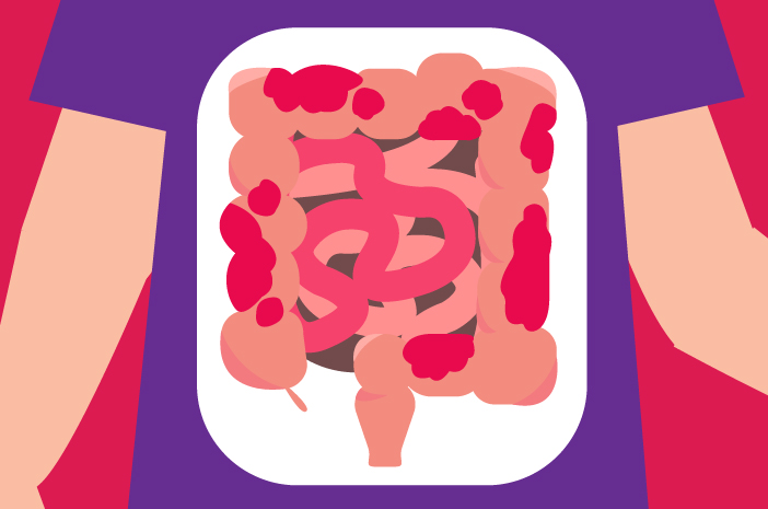 Bisakah Colon Cancer Dideteksi Sejak Dini?