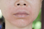 mengenal-perioral-dermatitis-dan-gejalanya-halodoc