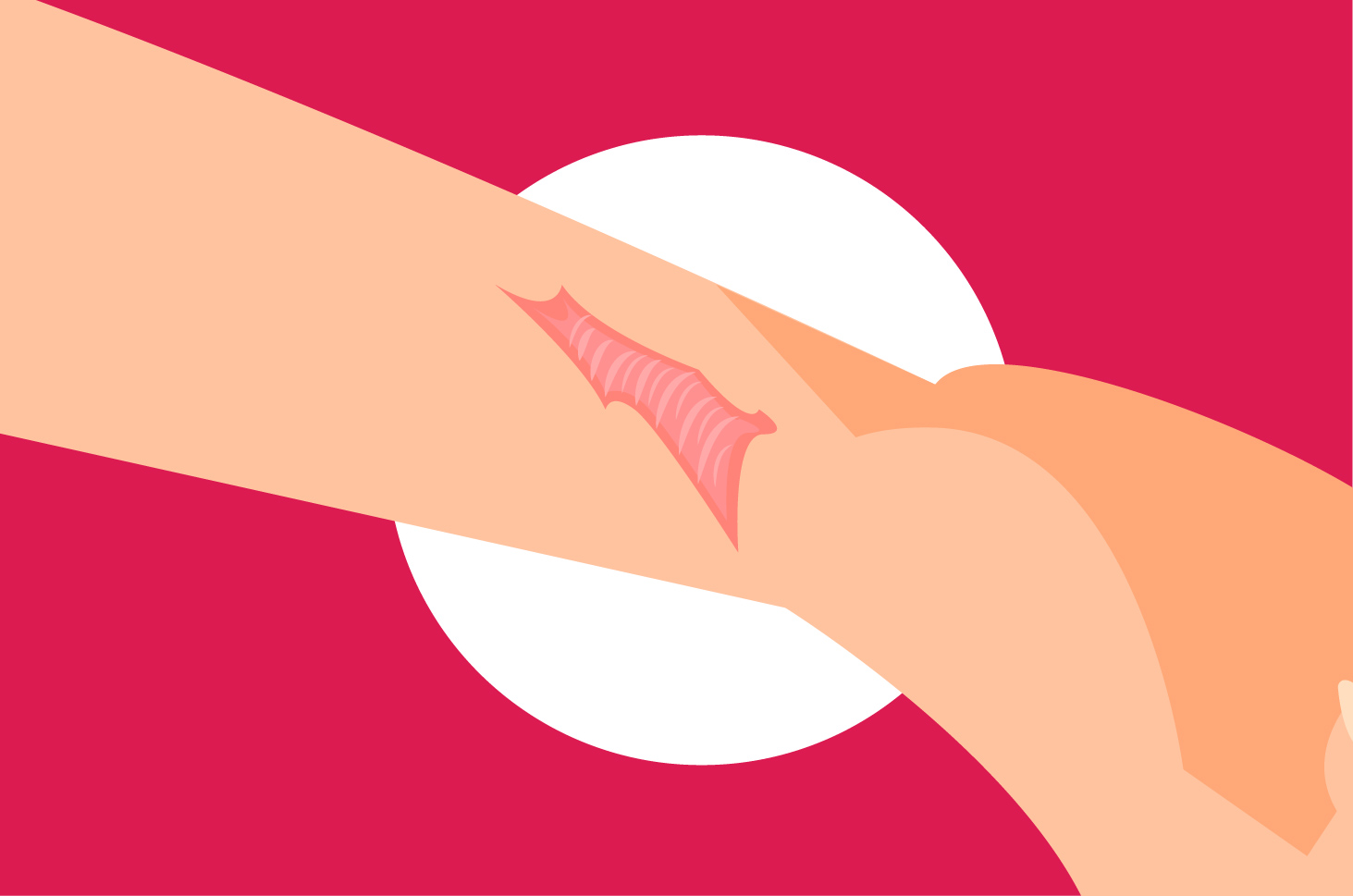 Apa Saja Hal yang Bisa Menyebabkan Keloid?