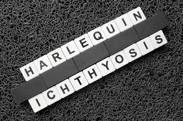 Perlu Waspadai Komplikasi Akibat Harlequin Ichthyosis