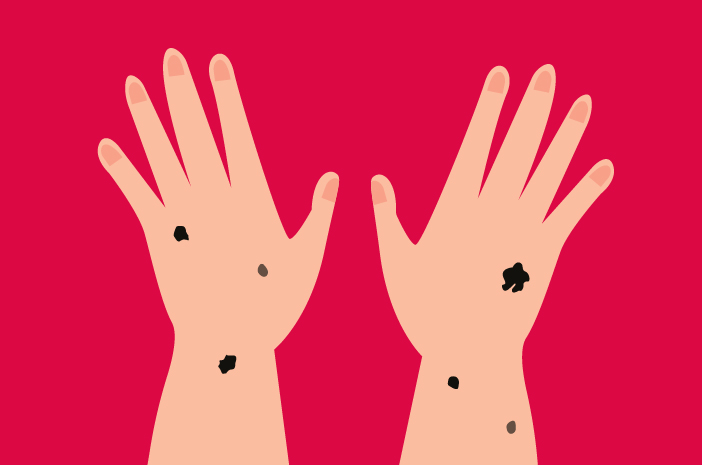 Jenis-Jenis Kanker Kulit Melanoma dan Cara Mencegahnya