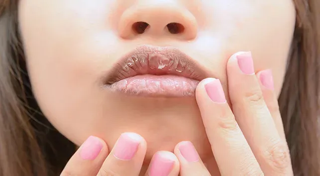 6 Cara Atasi Masalah Bibir Pecah-Pecah Saat Bulan Puasa