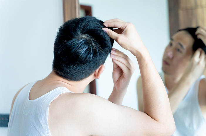7 Fakta Transplantasi Rambut untuk Mengatasi Kebotakan