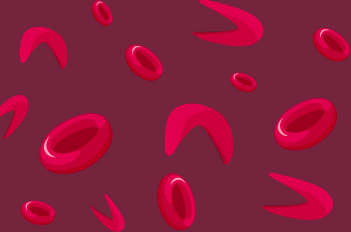 Inilah 8 Fakta Mengenai Anemia Sel Sabit