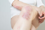 GLP-1 Agonist untuk Psoriasis dan Hidradenitis Suppurativa, Ini Faktanya
