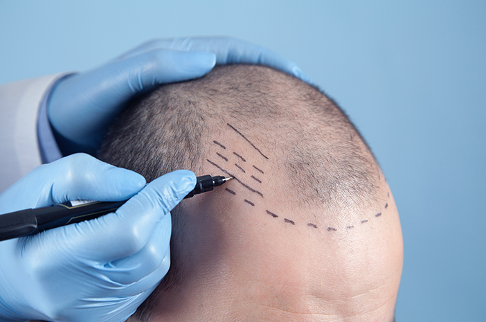 Transplantasi Rambut