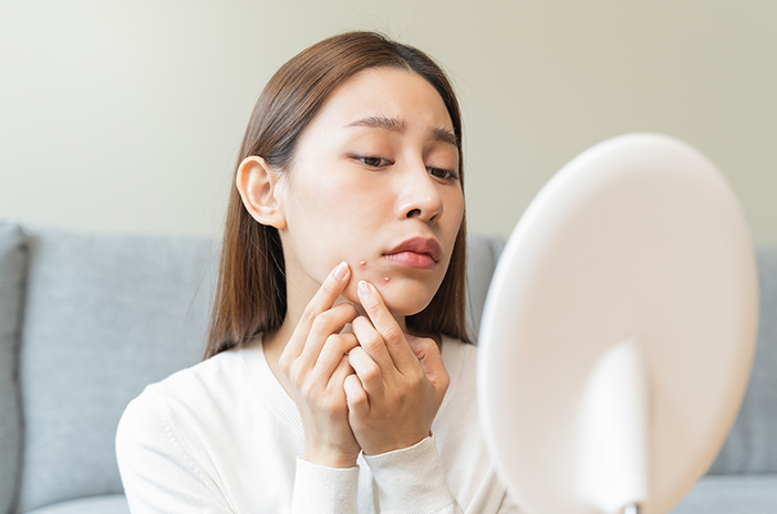 Isotretinoin Mampu Redam Jerawat Muncul di Muka, Efektifkah?