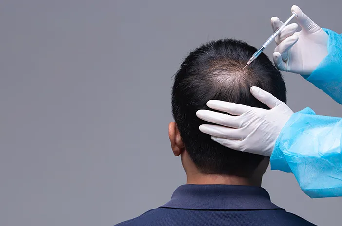 Atasi Kebotakan, Ini 5 Fakta Seputar Transplantasi Rambut