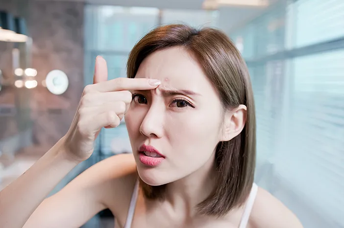 Seberapa Efektif Microneedling Mengatasi Jerawat?