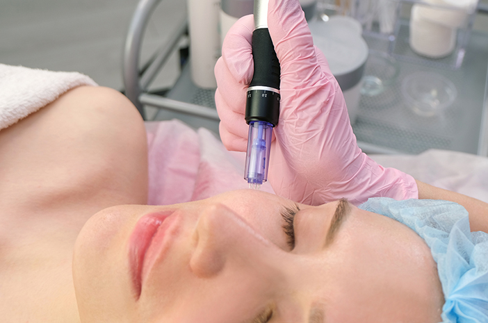 Perhatikan 4 Faktor Ini Sebelum Terapi Microneedling