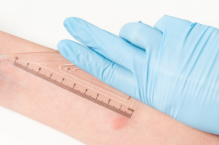 Adakah Hal yang Perlu Dilakukan Jelang Tes Mantoux?