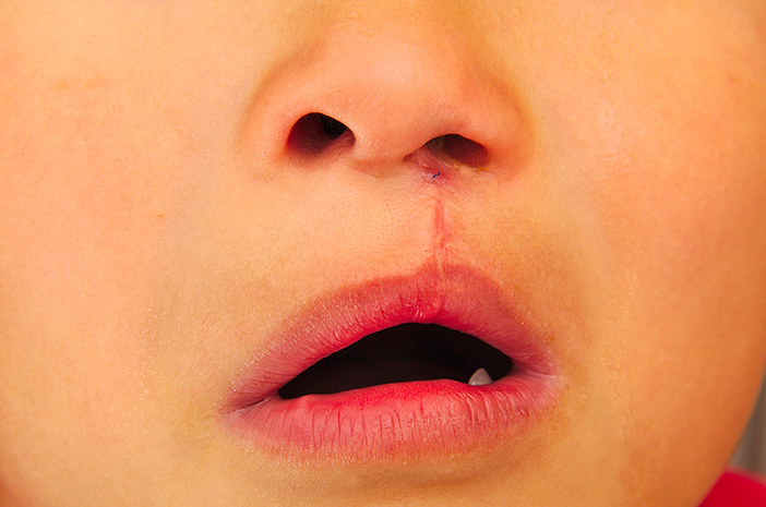 4 Komplikasi Bibir Sumbing yang Perlu Diwaspadai