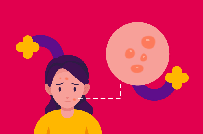 Kandungan Skincare untuk Mengatasi Jerawat Papula