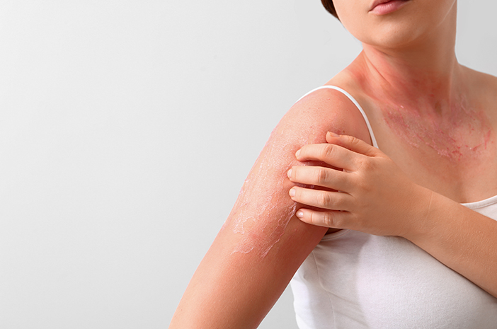 Ini Waktu yang Dibutuhkan agar Sunburn Bisa Sembuh