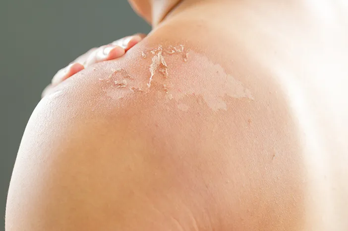 Benarkah Kulit Bersisik Jadi Gejala Awal Psoriasis?
