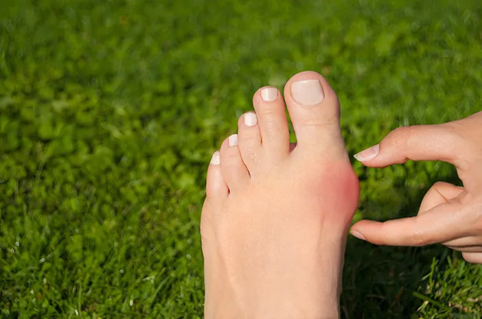 3 Komplikasi Bunion pada Jari Kaki yang Perlu Diwaspadai