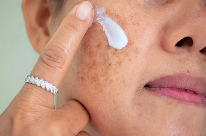 5 Cara Mengatasi Bintik Cokelat Lentigo pada Kulit Wajah