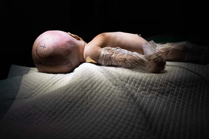 Cek Fakta: Bisakah Pengidap Hidrosefalus Sembuh?