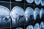 Tips Perawatan Pasca Craniotomy agar Pemulihan Lebih Optimal