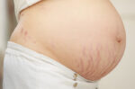 Cara Menghilangkan Stretch Mark saat Hamil agar Kulit Mulus