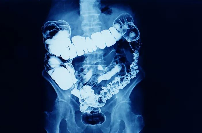 Barium Enema, Tindakan Medis Memeriksa Kelainan di Usus Besar