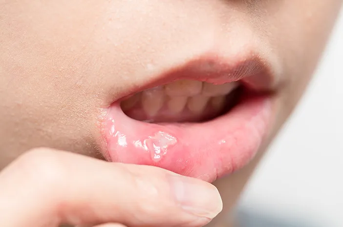Ini 4 Penyakit yang Bisa Diatasi dengan Obat Dequalinium Chloride