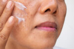 Efek Samping Miconazole
