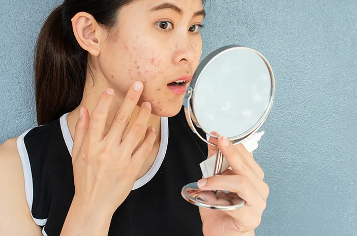 Deretan Obat Menghilangkan Jerawat yang Bisa Dicoba
