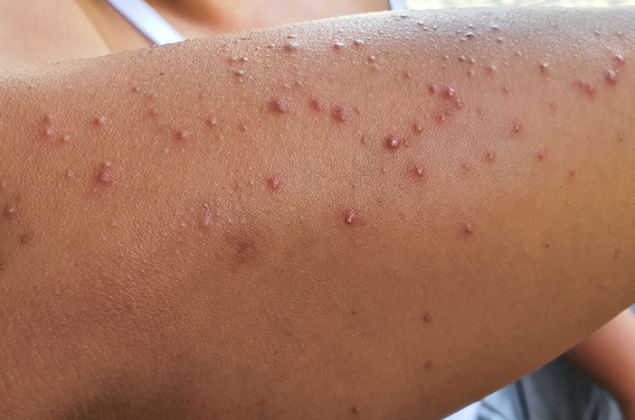 Jerawat di Tangan, Penyebab dan Cara Mengatasinya