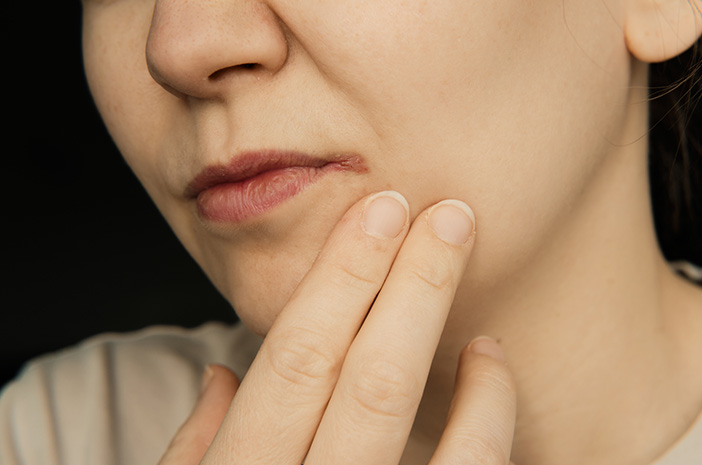  Angular Cheilitis: Penyebab, Gejala, Diagnosis, dan Pengobatan 