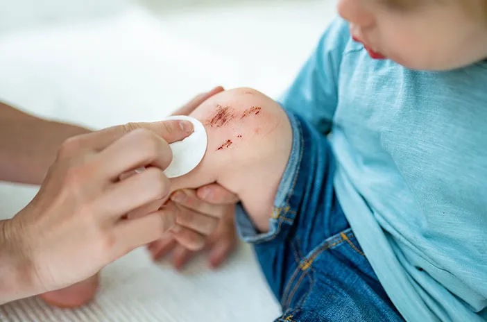 Ibu Ini 5 Cara Mengatasi Luka Lecet Anak agar Tidak Infeksi