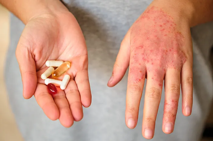 Dexamethasone vs Cetirizine, Mana yang Lebih Efektif Redakan Alergi?