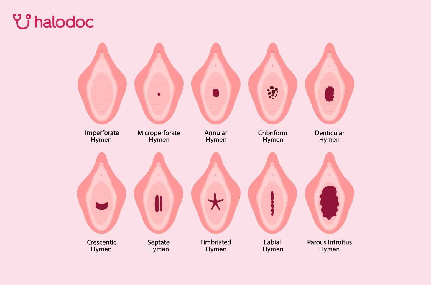 Mengenal Bentuk Dan Gambar Selaput Dara Pada Wanita