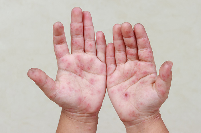 Flu Singapura pada Anak, Ini Penyebab, Gejala, dan Pengobatannya