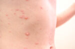 varicella zoster