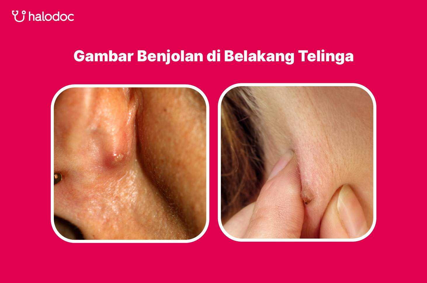 Ini Penyebab Benjolan di Belakang Telinga dan Cara Mengobatinya