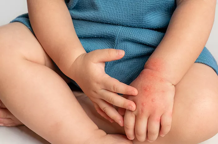 Biang Keringat Pada Anak: Gejala, Penyebab, dan Cara Mengobatinya