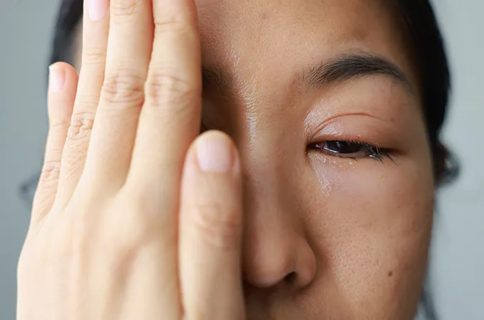 Kelopak Mata Bengkak, Ini Penyebab dan Cara Mengatasinya